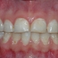 Bildet viser tenner som har vært utsatt for syrepåvirkning.