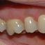 Bildet viser tenner i overkjeven med normale tannkjøtts¬forhold.