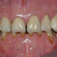 Bildet viser et eksempel på alvorlig tanngnissing.