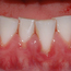 Bildet viser hvordan belegg har ført til rødt og hovent tannkjøtt ved flere tenner.