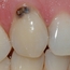 Bildet viser en hjørnetann i overkjeven der et hull har oppstått ved tannkjøttskanten.