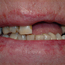 Bildet viser en pasient som mangler flere tenner i overkjeven. De gjenstående tennene er svekket av hull og fyllinger. Det var ønskelig å restaurere tennene med en bro, festet på pasientens egne tenner, samt 2 implantater.