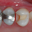 Tannen er ferdig borret og klargjort for fyllingsterapi.