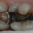 Bildet viser en tann der infraksjonslinjen over tid har ført til at tannen har delt seg i to.