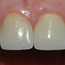 Bildet viser resultatet etter at tennene er reparert med keramiske kroner.