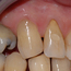 Tannen blir derfor reparert med en fylling.