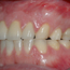 Bildet viser et eksempel på moderat tannslitasje som følge av tanngnissing.