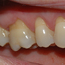 Bildet viser hvordan tannkjøttet over tid har trukket seg tilbake som følge av for hard tannbørsting.