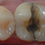 Bildet viser en tann der infraksjonslinjen over tid har ført til at tannen har delt seg i to.