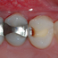 Tannen er borret delvis opp, og man kan se hvordan kariesangrepet strekker seg inn i tannen.