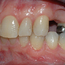Bildet viser en manglende tann i overkjeven. Nabotennene har fyllinger og tilfellet egner seg derfor godt for brobehandling.