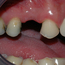 Bildet viser en manglende tann i overkjeven. Nabotennene har fyllinger og slitasje, og tilfellet egner seg derfor godt for brobehandling.