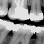 Røntgenbilder viser blant annet begynnende hull, behandlingskrevende hull, gamle fyllinger og tennenes beinfeste.
