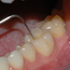 Tannlegen/tannpleieren undersøker hver enkelt tann etter hull og skader.