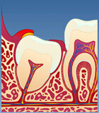 Fig 2: Plakk og matrester kan legge seg inn under tannkjøttet og resultere i plagsomme betennelser
