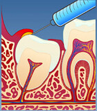 Fig 3: Tannlegen kan skylle bort bakteriene og på denne måten løse problemet midlertidig