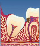 Fig 6: Vansker med renhold kan over tid kan også gjøre at det utvikles hull i tannen foran