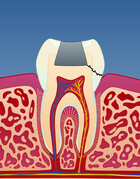 Fig 2: I tenner med store fyllinger kan det utvikles sprekker som medfører at tannen knekker
