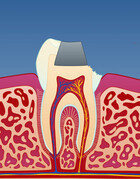 Fig 4: I tenner med store fyllinger kan det utvikles sprekker som medfører at tannen knekker